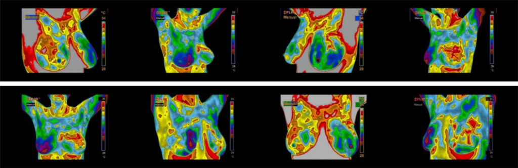 Mammogram image showing breast tissue with a bright spot.